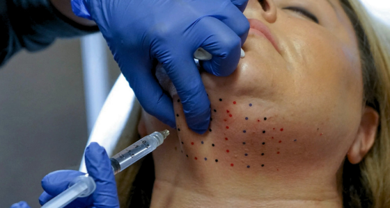 Kybella®