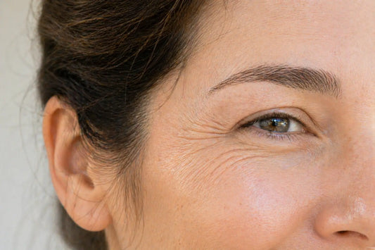 How to Get Rid of Crow's Feet (Without Surgery)