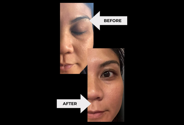 Microneedling with Vitamin C: Renew Your Skin's Glow